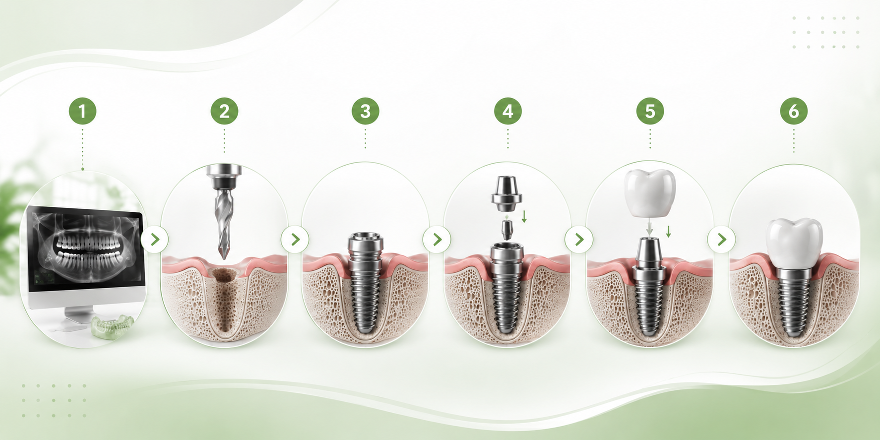 Aufbau eines Zahnimplantats – Krone, Abutment und Implantat im Kieferknochen